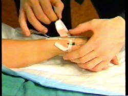 starting an IV